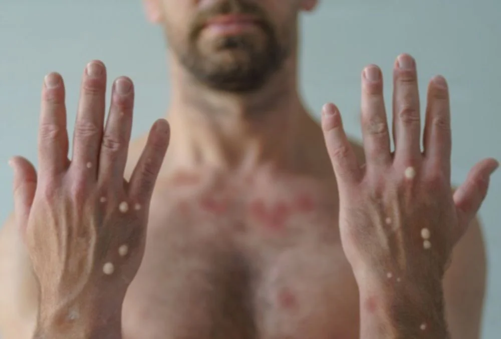 mpox cases South Africa Four New Mpox Cases Take South